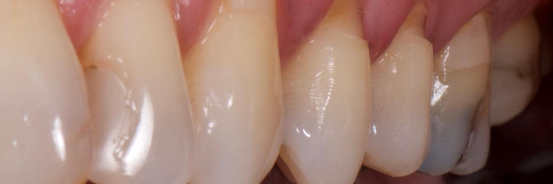 What causes the wear and tear on my teeth Other Blacklick OH