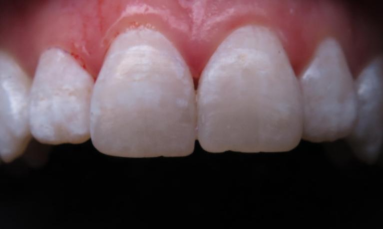 Brown-spot-removal-After-Image