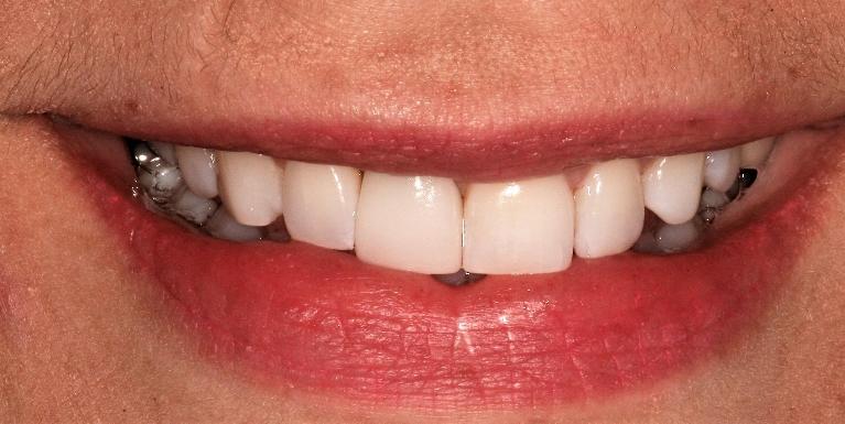 Implant-Crown-After-Image