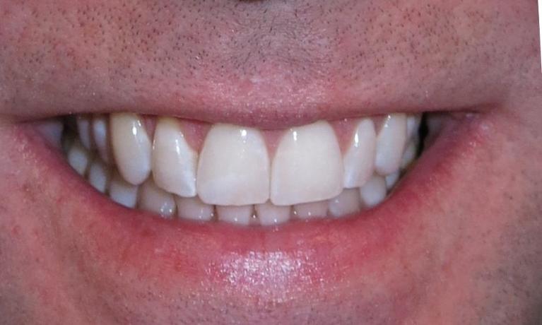Invisalign-After-Image
