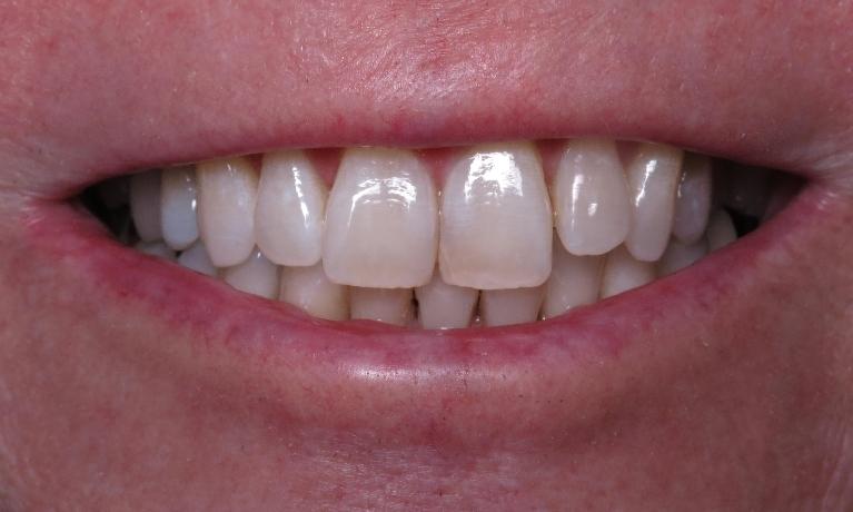 Whitening-After-Image
