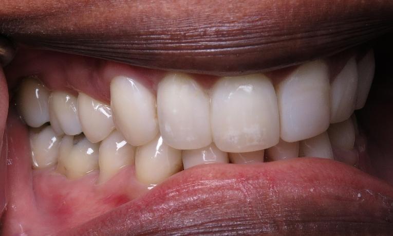 Composite-Filling-After-Image