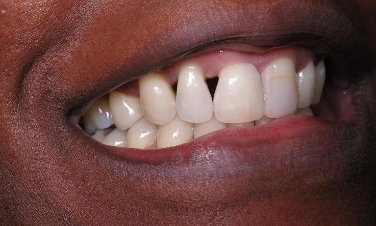 Composite-Filling-Before-Image