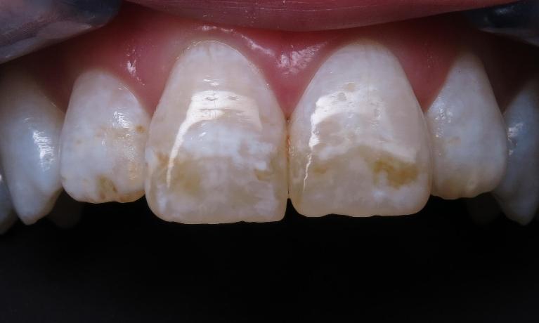 Brown-spot-removal-Before-Image