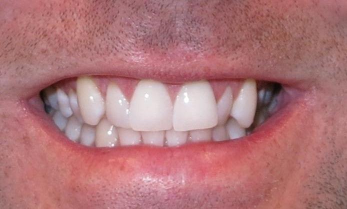 Invisalign-Before-Image