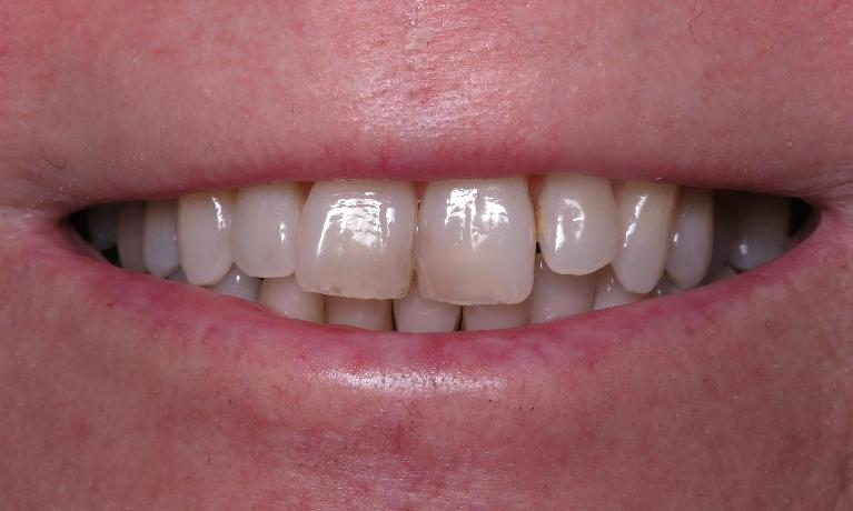 Whitening-Before-Image