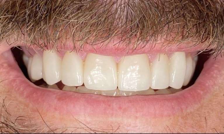 Crowns-After-Image