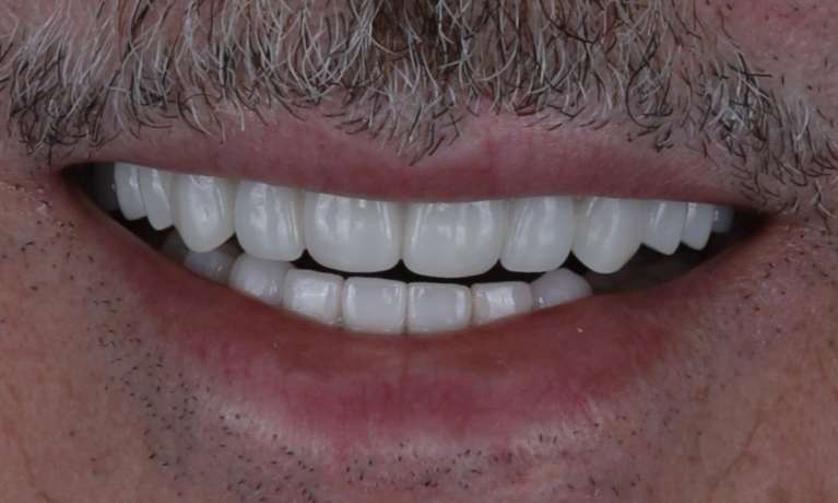 Implant-Supported-Denture-After-Image