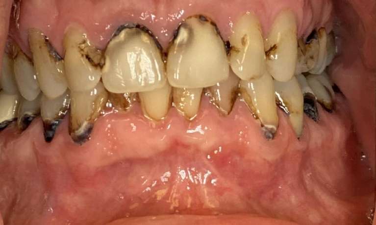 Crowns-Before-Image