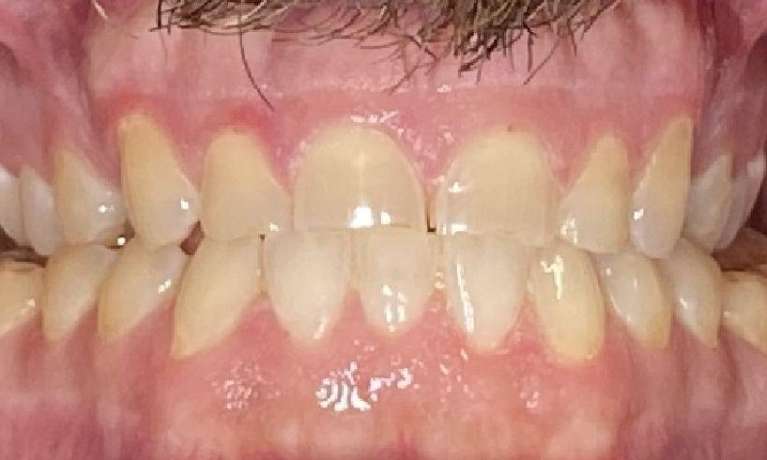 Crowns-Before-Image
