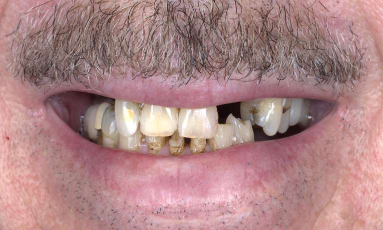 Implant-Supported-Denture-Before-Image